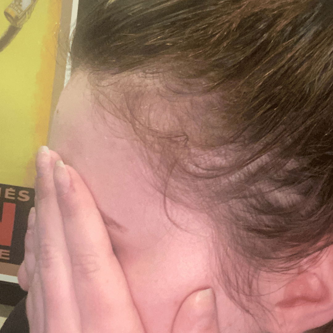 Drew Resist Co-Founder Hair Loss